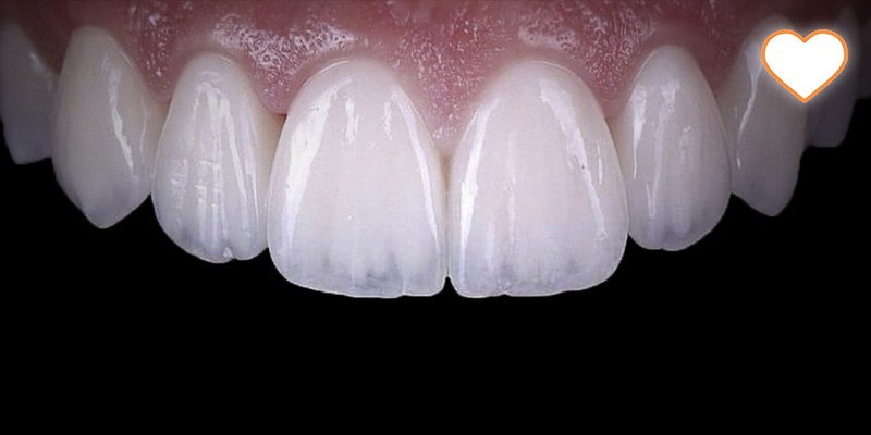 Особенности реставрации зубов фронтальной группы у молодых пациентов