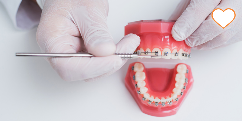 Анализ биомеханики для успешного ортодонтического лечения