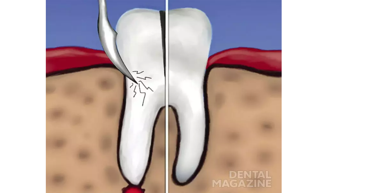 2 корня в зубе. Резекция,ампутация,гемисекция корня. Резекция верхушки корня зуба гемисекция и ампутация корня. Гемисекция многокорневого зуба.