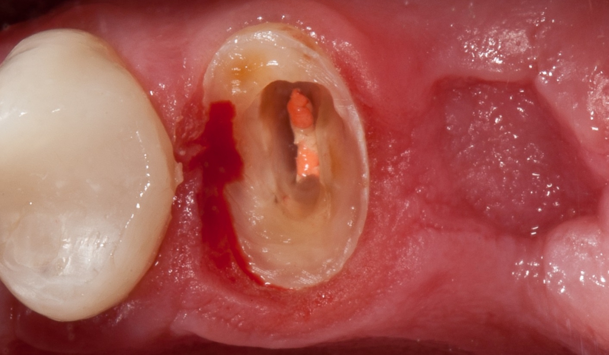 Феррул-эффект в стоматологии: что это такое? | Colgate®