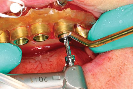 Установка зубного имплантата с помощью 3D-печатных хирургических шаблонов