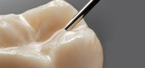 Эффективность стеклоиономерных цементов для герметизации фиссур молочных зубов у детей