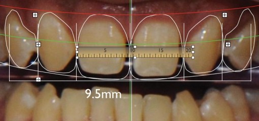 Цифровой дизайн улыбки и денто-лицевой анализ: как восстановить эстетику, сохранив структуру зубов?