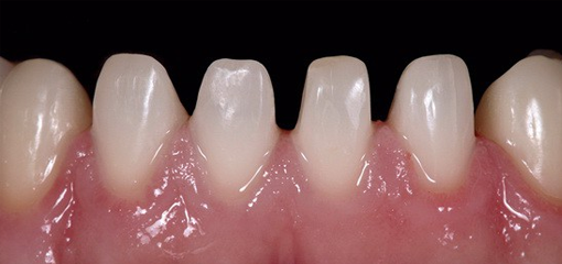 Дефекты твёрдых тканей зубов, возникшие в результате стирания или эрозии