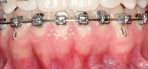 Регенерация кости после альвеолярной дегисценции при ортодонтическом перемещении зубов – описание клинического случая
