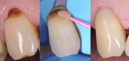 Пришеечная реставрация зуба