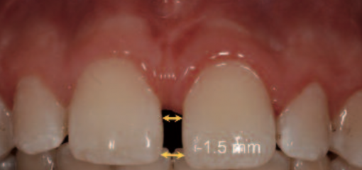 Лазерная френэктомия в детской стоматологии
