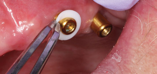 Фиксация матриц для съемных протезов с опорой на имплантаты в полости рта