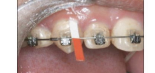 Уровень субстанции P в десневой жидкости у пациентов, проходящих ортодонтическое лечение на брекет-системе Damon