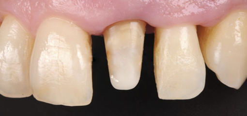 Реставрационный интерфейс в эстетической стоматологии – диоксид циркония