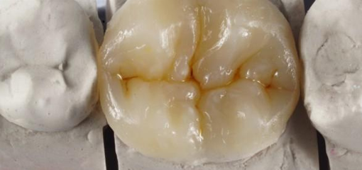 Трещина зуба: препарирование с использованием постепенно обрезаемой силиконовой матрицы