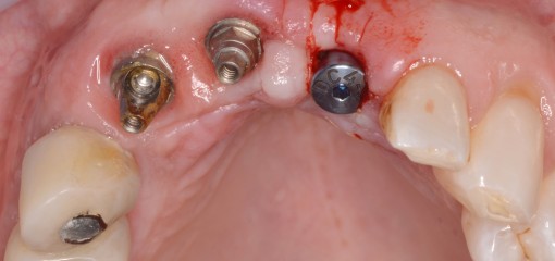 Эстетическая реабилитация пациента с имеющейся имплантацией во фронтальном отделе верхней челюсти