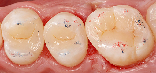 Воссоздание контактных пунктов в случаях ротации нескольких зубов