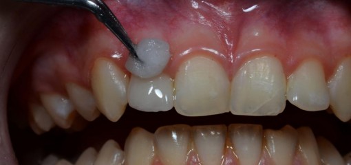 Протокол композитного восстановления зубов с переломом коронки