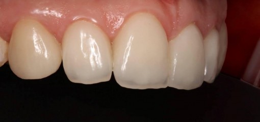 Изменение формы, ангуляции и цвета фронтальной группы зубов с помощью реставраций из прессованной керамики