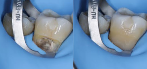 Использование модифицированного кламмера 212 для лечения пришеечного кариеса и некариозных пришеечных поражений на соседних зубах