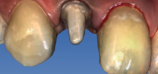 Цельнокерамическая реставрация переднего зуба по CAD/CAM-технологии в одно посещение