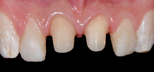 Препарирование зуба с формированием уступа