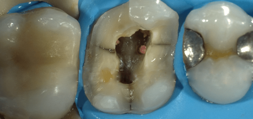 Лечение трещины зуба