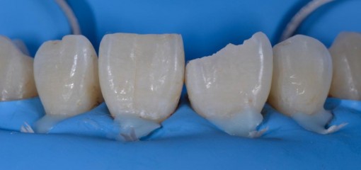 Реставрация скола коронки зуба по IV классу, осложненного отделением небного фрагмента