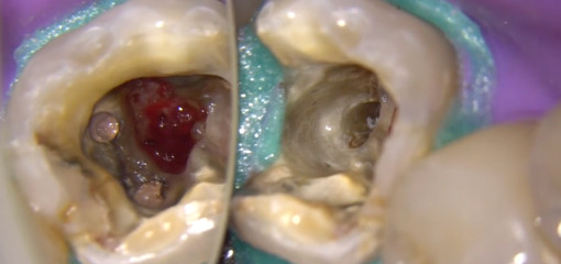 Лечение большой перфорации дна полости зуба