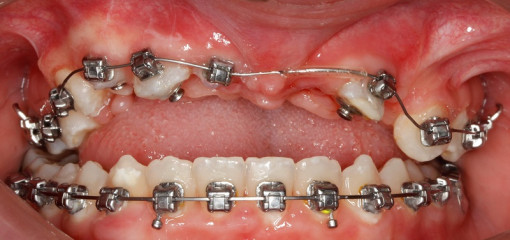 Междисциплинарное лечение пациента с ретенцией зубов