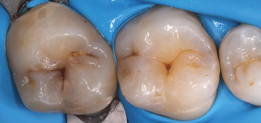 Методики восстановления жевательных зубов. Модифицированный подход.