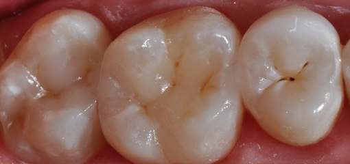 Прямая реставрация боковых зубов. Случай №3