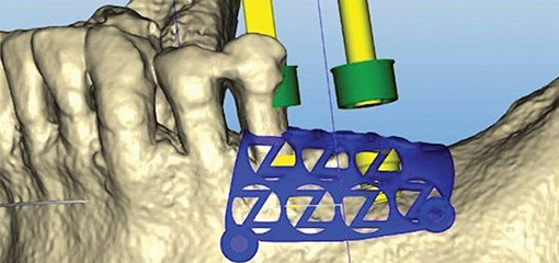 Увеличение объема с альвеолярного гребня при помощи титановой сетки с использованием технологии CAD/CAM для проектирования и печати