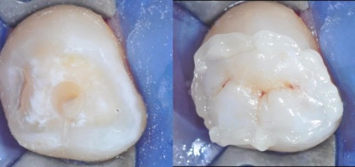 Новые перспективы в области лечения повышенной стираемости зубов: восстановление окклюзионных поверхностей