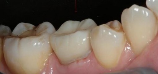 Аутотрансплантация зуба ребенка в смешанном прикусе
