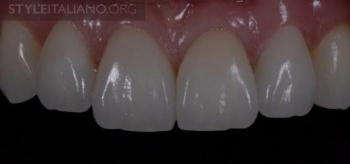 Сила "четырех" и сохранение тканей зубов