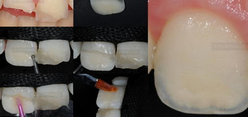 Клиническое и научное руководство по реплантации отломков зуба