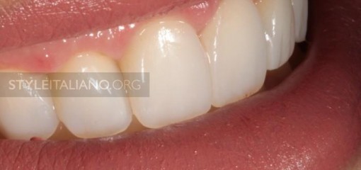 Минимально инвазивное решение для прямых композитных реставраций передних зубов