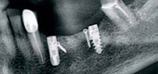 Комбинация  методов  аугментации костной ткани при установке дентальных имплантатов на нижней челюсти
