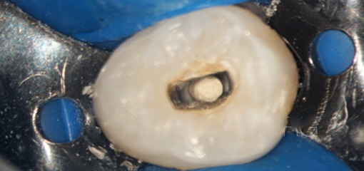 Апексификация несформированного зуба с апикальным периодонтитом и свищевым ходом. Разбор клинического случая