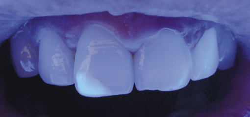 Воссоздание трехмерной оптической модели тканей зубов