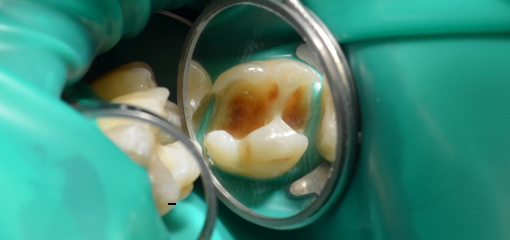 Особенности эстетико-функциональной реставрации зубов