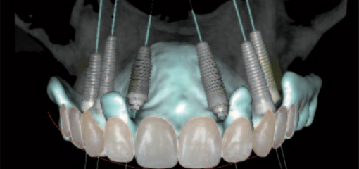 Цифровое моделирование улыбки и шаблонов для установки имплантатов и их моментальной нагрузки при частичной адентии