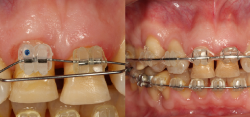 Ортодонтическое вытяжение как способ увеличения объема тканей в области имплантата: новая классификация, основанная на анатомии и клинических результатах