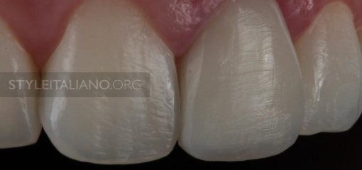 Реставрация центрального резца, неотличимая от соседнего зуба