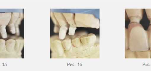 Мостовидный протез с опорой на естественные зубы и имплантаты: обзор клинических осложнений