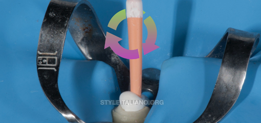 Биокерамика и адгезия: подготовка корневого канала под стекловолокно с помощью техники одного конуса