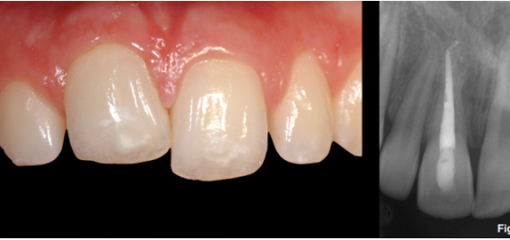 Анкилоз. Часть 3 (из 5): Лечение детей с анкилозом постоянных зубов