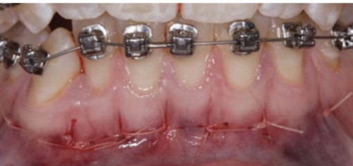 Ортодонтическое лечение при помощи пьезоцизии с применением индивидуализированных ортодонтических аппаратов, изготовленных по методу CAD/CAM: рандомизированное контролируемое исследование взрослых пациентов