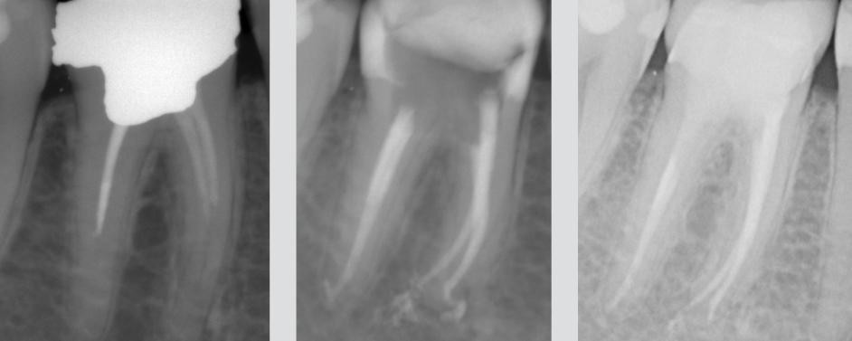 1 корневой канал. Обтурация корневого канала рентген. Апикальный периодонтит рентген. Пломбировка каналов зуба рентген.