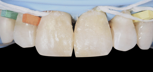 Техника “крыла” для реставрации фронтальной группы зубов