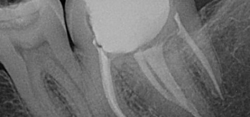 Применение конусно-лучевой компьютерной томографии при эндодонтическом лечении анатомически слитых второго и третьего моляров нижней челюсти