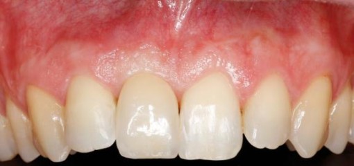 Одномоментная имплантация и одновременное замещение дефекта зубных рядов