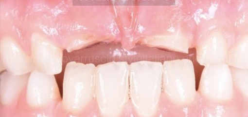 Восстановление естественности: лечение осложненного горизонтального перелома с помощью фиксации фрагмента зуба